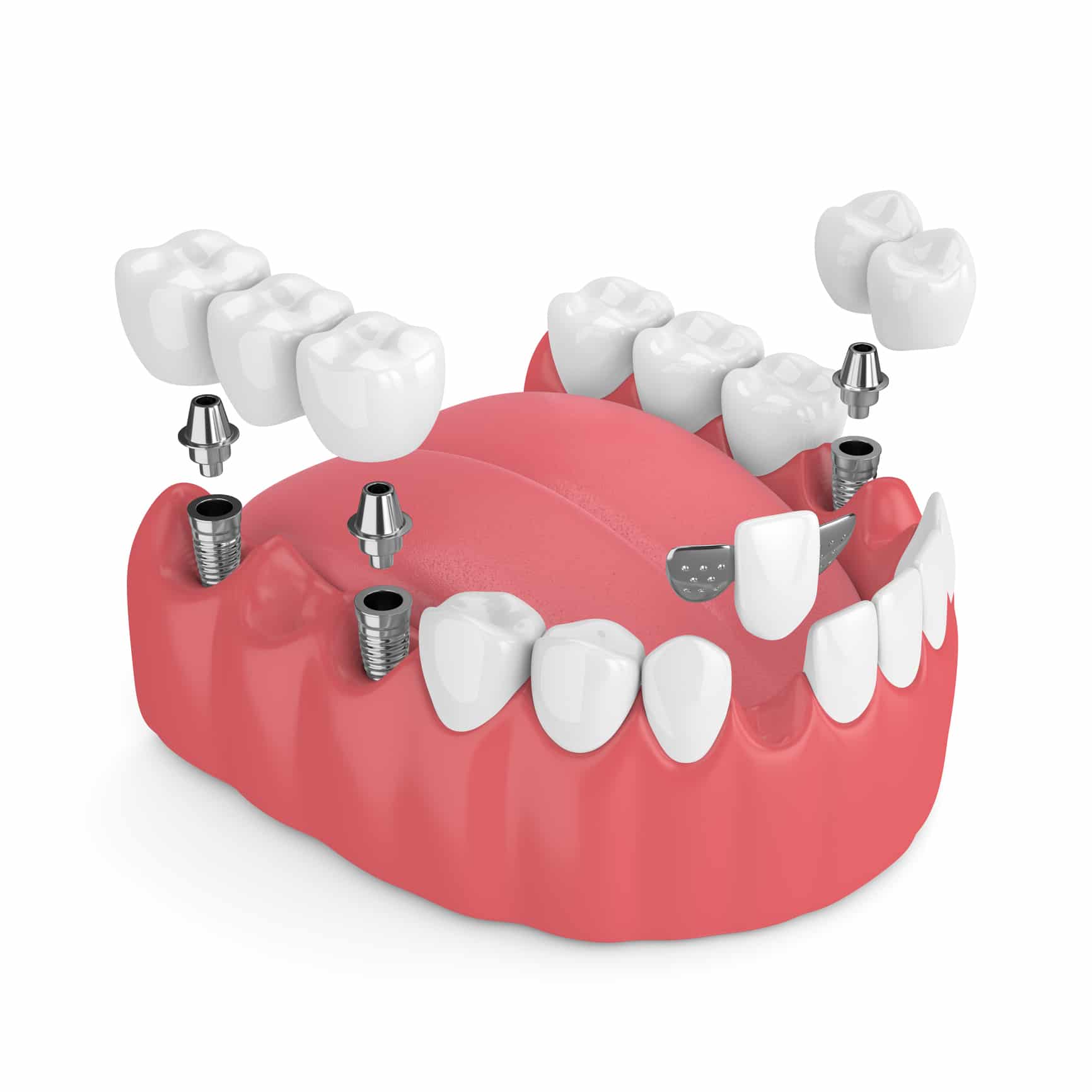 Dental Bridge or Implants? What is better?