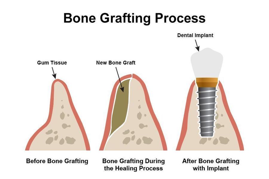 The process of restoring the volume of the jawbone