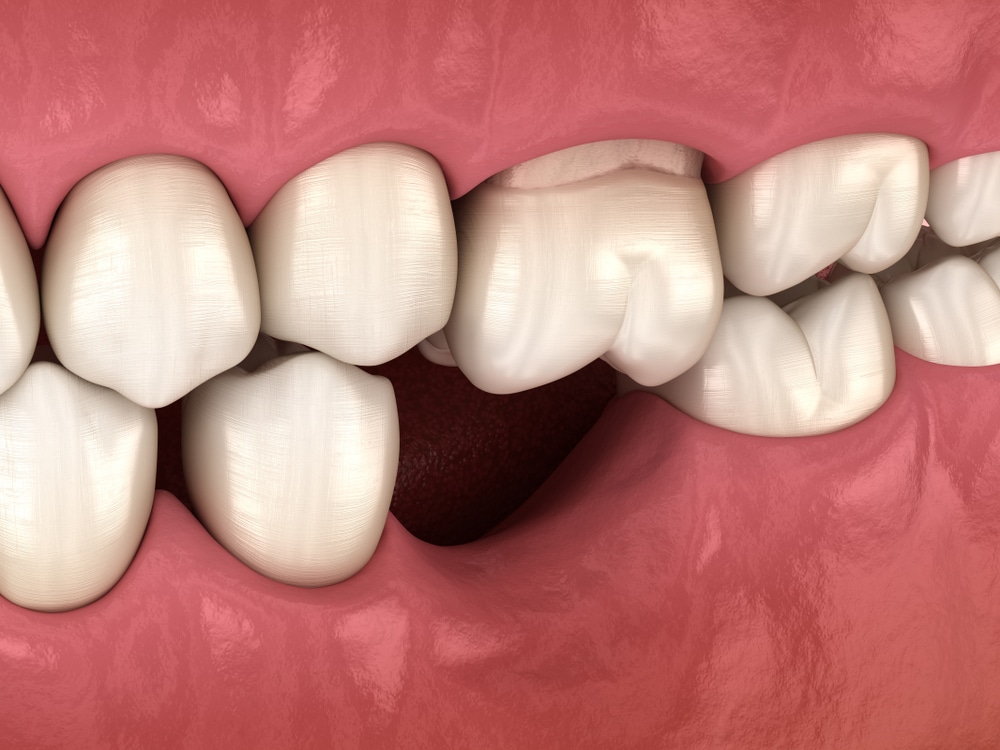 Protrusion of the antagonist tooth as a result of the absence of a tooth