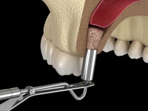 Elevation of the maxillary sinus and filling with bone material during a sinus lift