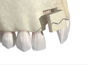 Bone augmentation in the upper jaw by bone block transplantation