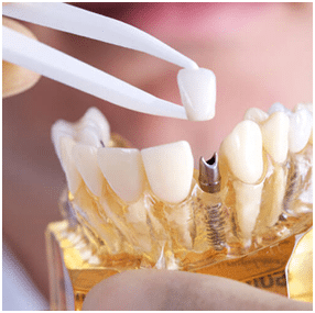 Dental Implants