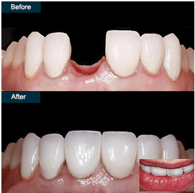 Before and After