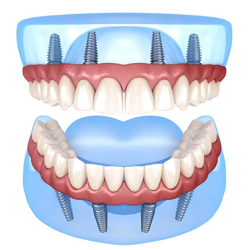 All-on-4 implant concept