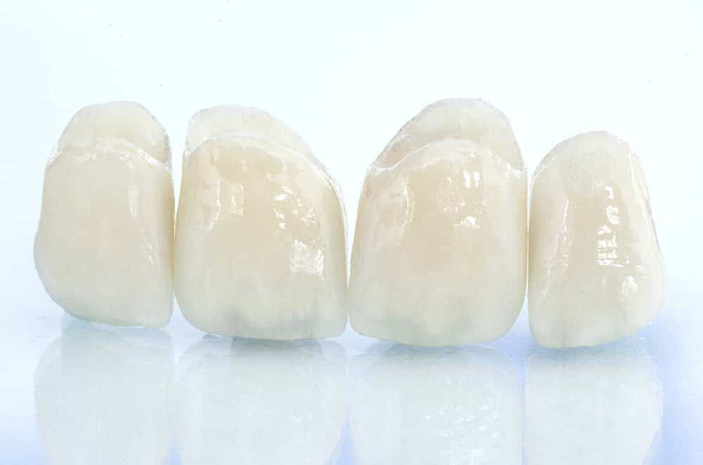 Ceramic crowns with flawless aesthetics