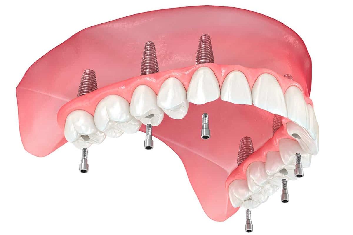 all on 6 in the maxilla - improved technology of the all-on-four protocol