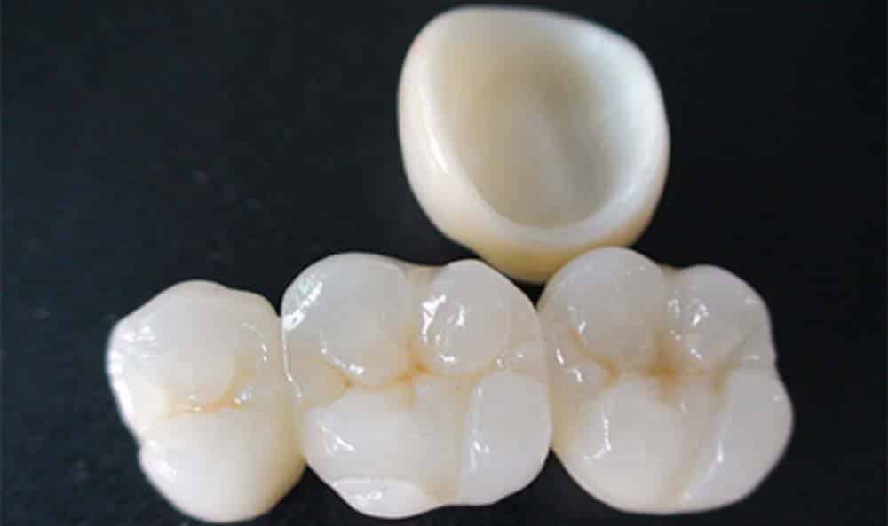 dental crowns