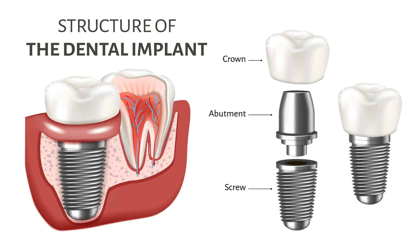 dental implantation