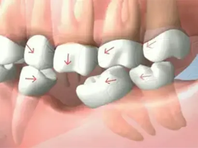 Displacement of neighboring teeth in the area of the defect in the absence of a tooth for a long time