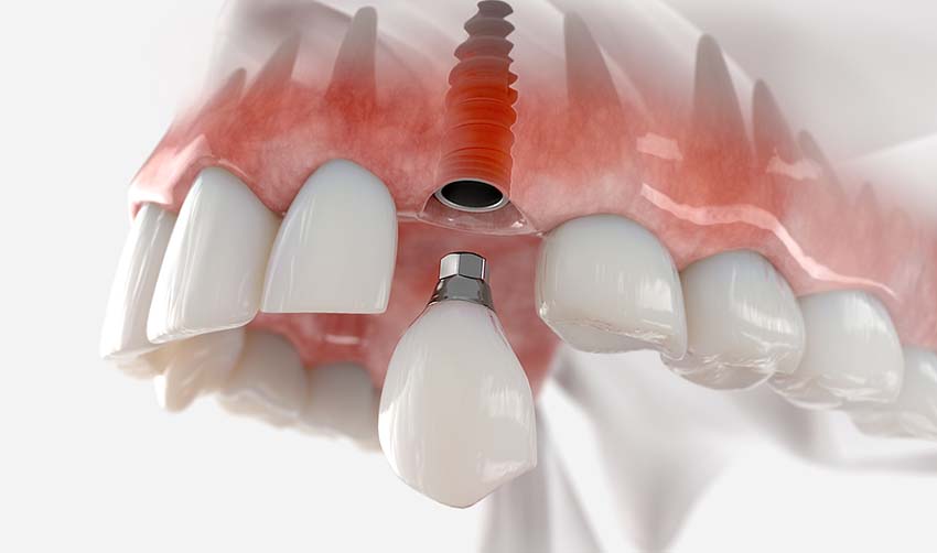 Installing an implant is the best solution if, due to a chip, it is necessary to remove a tooth and restore the integrity of the dentition