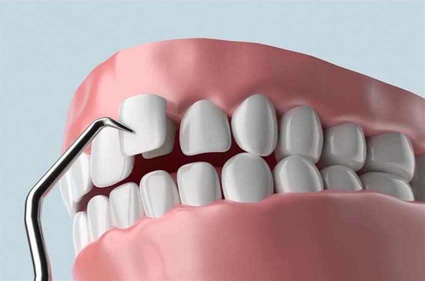The installation of veneers allows you to close cracks and chips on the front teeth