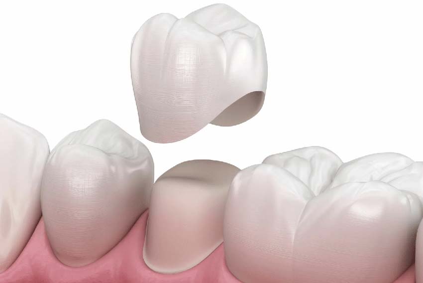 Zirconia crowns