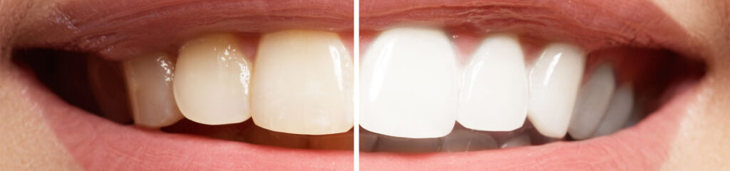 porcelain veneers