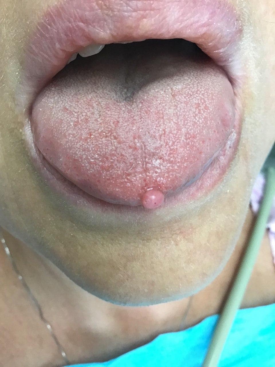 papilloma on the tongue