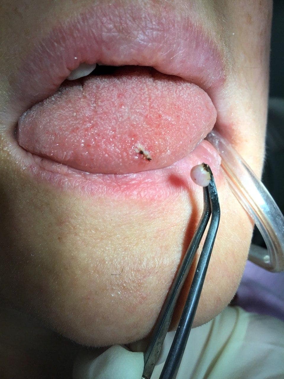 papilloma removal