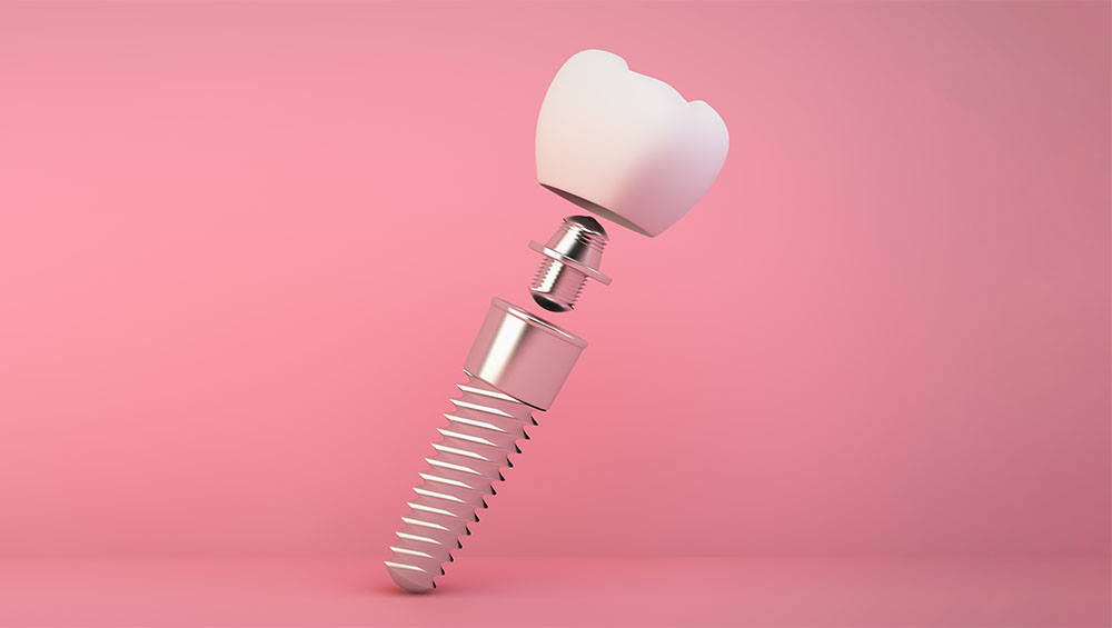 Dentures on implants