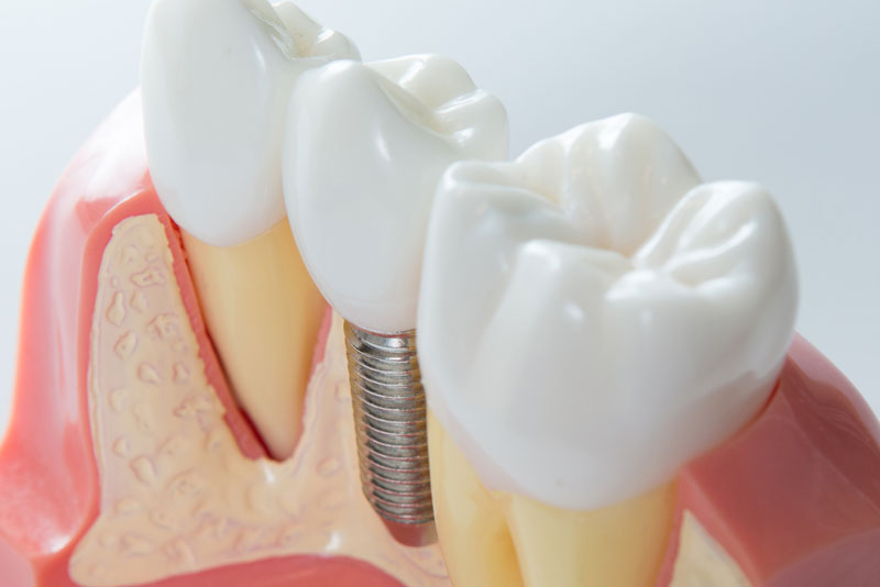 dental implant post digital model