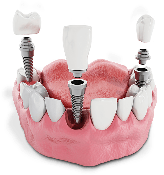 multiple dental implant model 1 1