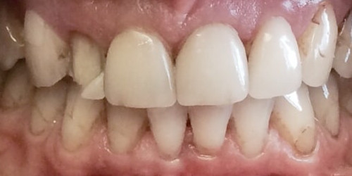 Полная реконструкция верхнего зубного ряда