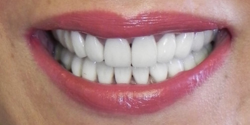 Реставрация всех зубов керамическими винирами