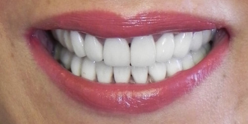 Restoration of all teeth with ceramic veneers