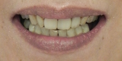 Restoration of all teeth with ceramic veneers