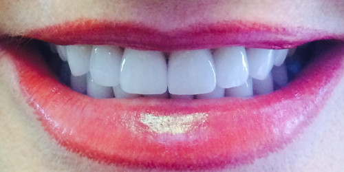 Восстановление сильно изношенных зубов
