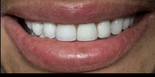 Treatment of a patient with bruxism