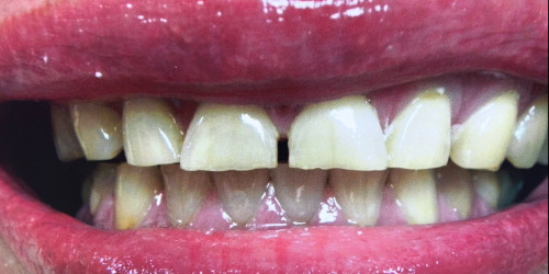 Treatment of a patient with bruxism