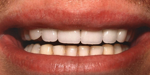 Treatment of a patient with bruxism