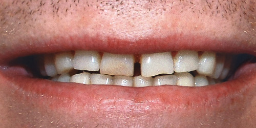 Treatment of a patient with bruxism