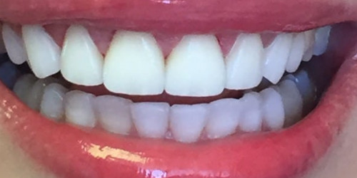 Improvement of aesthetics of upper teeth in the smile zone