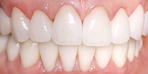 Replacement of old veneers