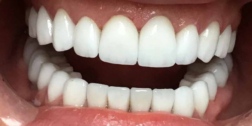 Bruxism treatment and bite correction