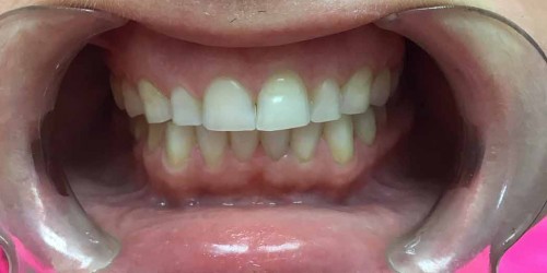 Bruxism treatment and bite correction