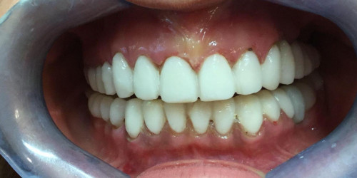 Restoration of teeth