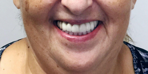 Front tooth restoration and mouth reconstruction