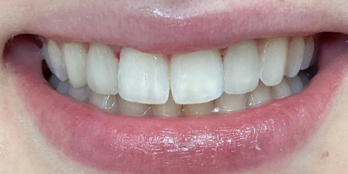 Косметическая стоматология улыбки для молодой девушки
