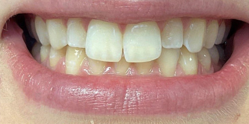 Cosmetic dentistry for a young girl’s smile