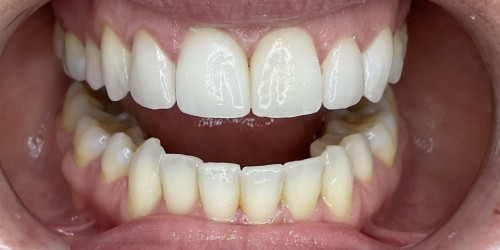 Установка виниров на 4 верхних центральных зуба