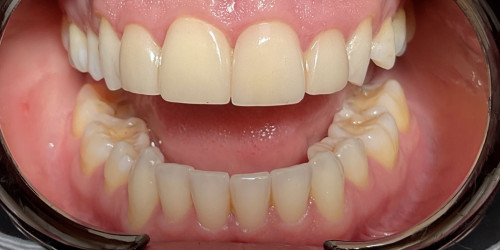Установка виниров на 4 верхних центральных зуба