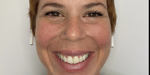 4 upper central teeth by veneers