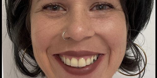 4 upper central teeth by veneers
