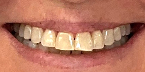 10 veneers were installed on the lower and upper jaws
