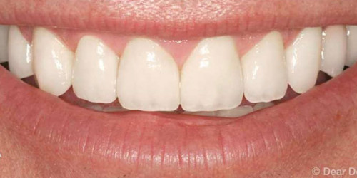 Restoration with dental inlays