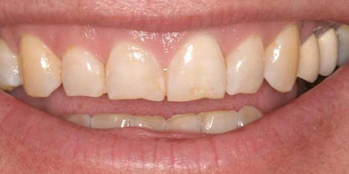 Restoration with dental inlays