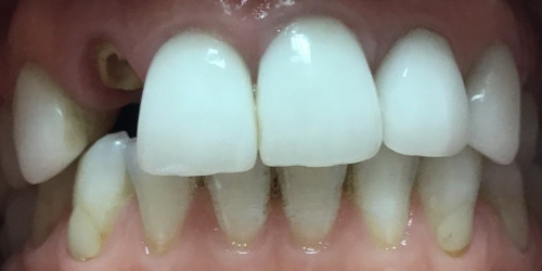 Restoration of a broken tooth