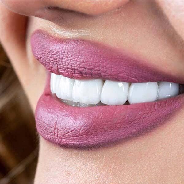 porcelain veneers